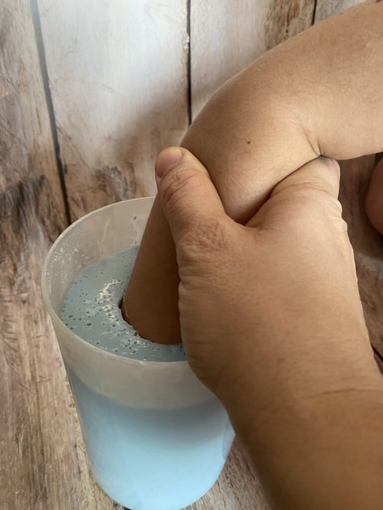 Une main moulée en plâtre dans un gant jetable